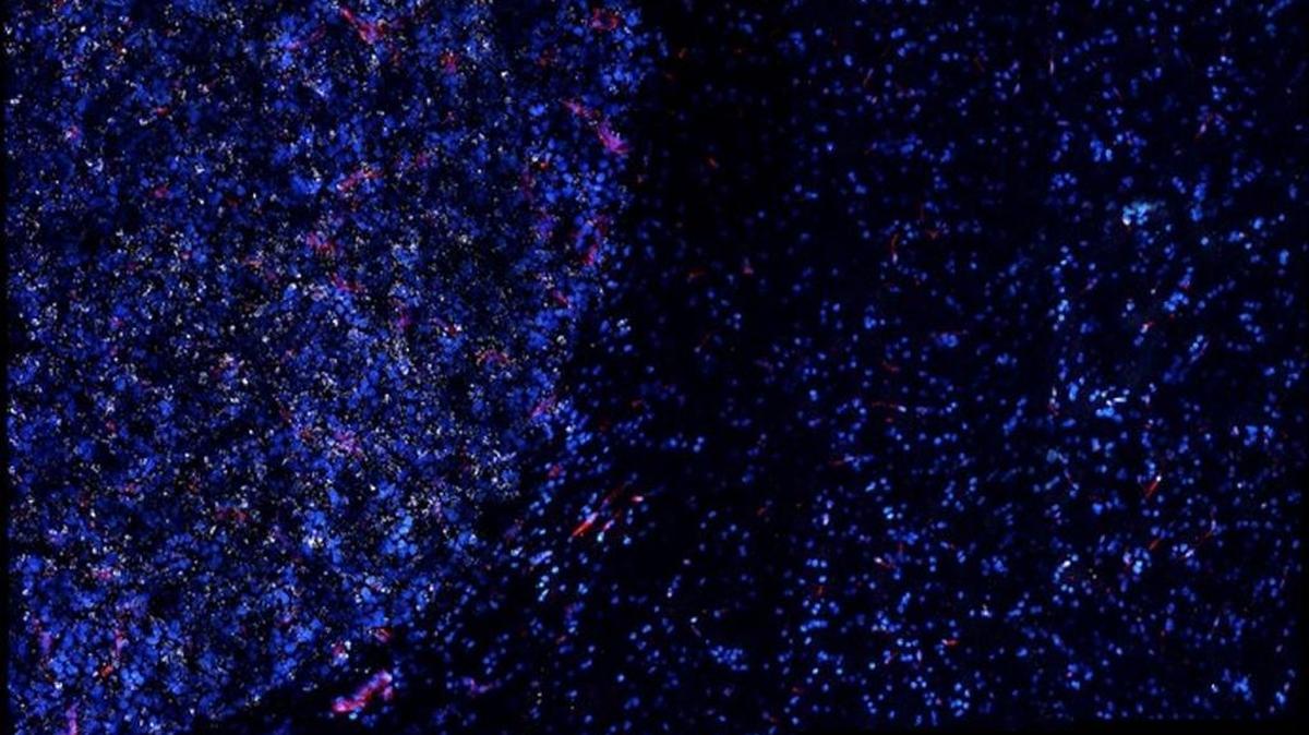 Gold nanostars (white spots) preferentially accumulate within a tumor (left) and are sparse in normal tissue (right).