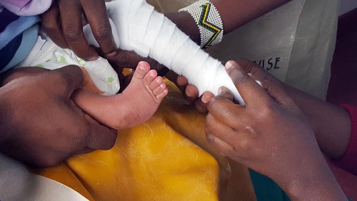 Health care workers apply the first cast for a child born with clubfoot. The two-month treatment is successful in 95 percent of cases and costs only $250 per child, MiracleFeet co-founder Chesca Colloredo-Mansfeld said.