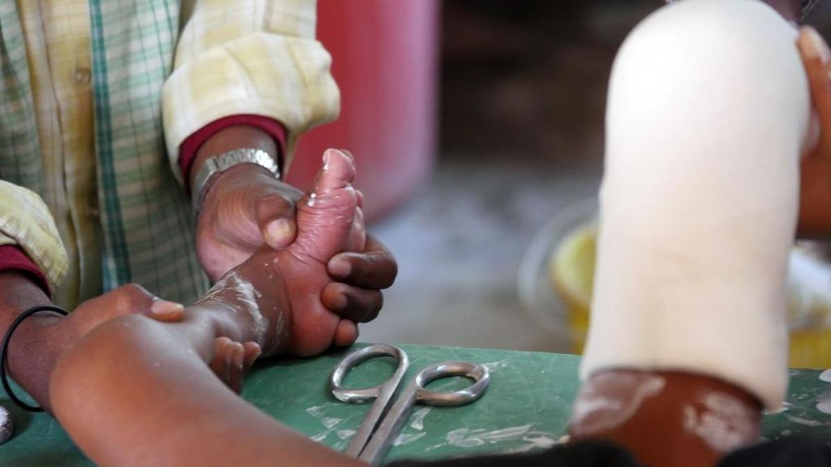 Roughly one in 800 children are born with clubfoot, a congenital disease that can run in families. The disease causes the feet to turn in and up, crippling the children.